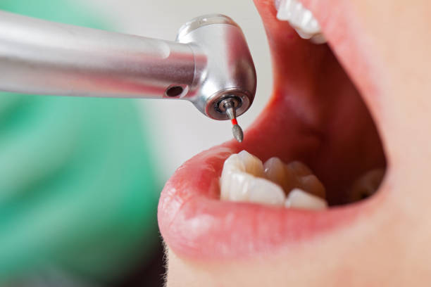 Best Chipped Tooth Repair Near Me  in Lowry Crossing, TX